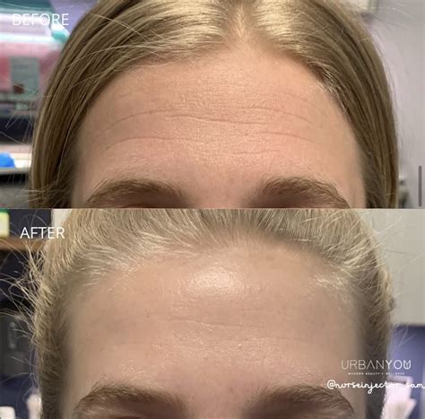 Image result for Botox Injection Pattern Forehead