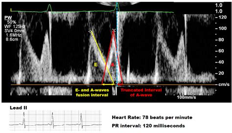 PR Interval as a Novel Therapeutic Target of Ivabradine Therapy ...