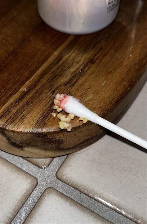 Tonsil stones and canker sores : r/tonsilstones