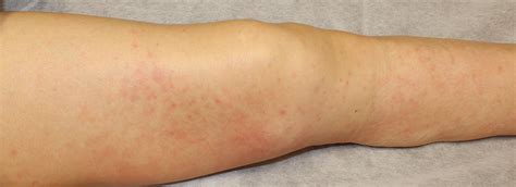 赤い発疹 熱なし かゆみなし | 痒くない蕁麻疹(じんましん)の14の症状と対処法！