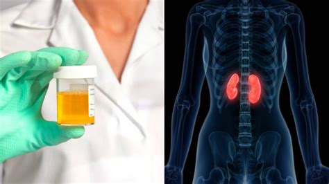 इस रंग का दिखे यूरिन तो समझ जाएं किडनी में है गड़बड़, तुरंत हो जाएं ...