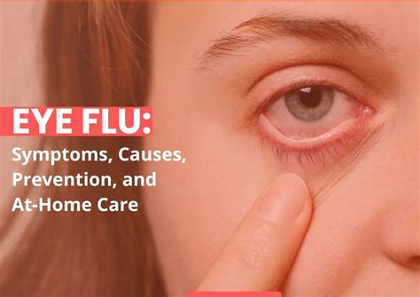 Understanding Eye Flu: Symptoms, Causes, and Treatment Options for ...