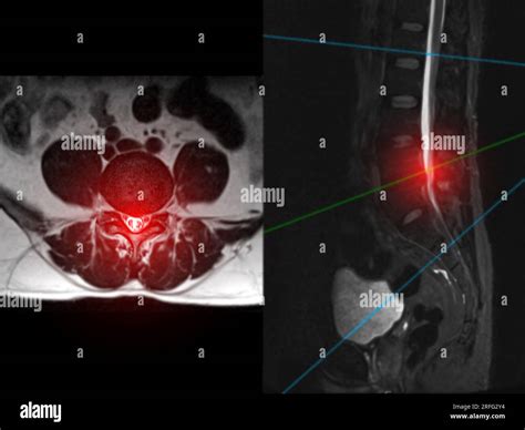 MRI L-S spine or lumbar spine Axial T2W view with sagittal plane for diagnosis spinal cord ...