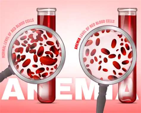Best Essential Oils for Anemia - How to Cure | AOS Blog