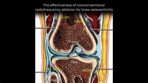 Controversies and insights in genicular nerve radiofrequency ablation ...