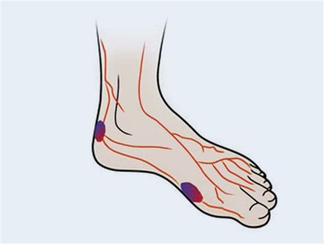 Buy Diabetic Insoles Online in India | Orthotics for Diabetic