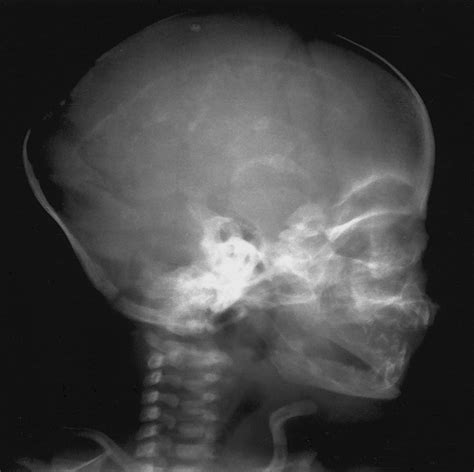 The Infant Skull: A Vault of Information | RadioGraphics
