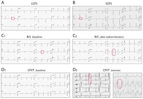 Ion Channel Disorders and Sudden Cardiac Death