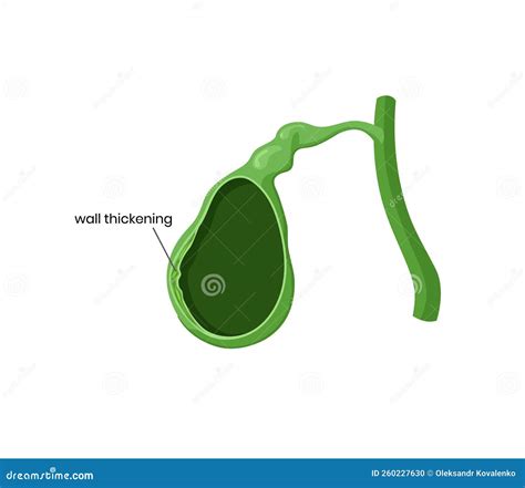 Illustration of the Gallbladder Wall Thickening. Vector Immage of the Gallbladder Anatomy with ...