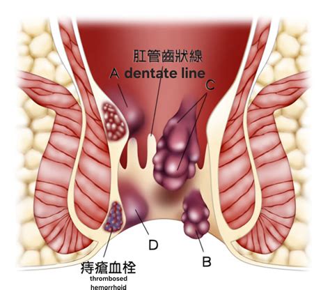 Prolapsed Internal Hemorrhoid
