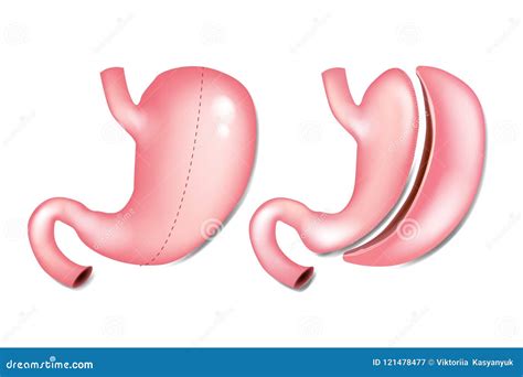 Vertical Sleeve Gastrectomy Stock Vector - Illustration of design, digestive: 121478477