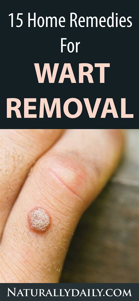 15 Home Remedies for Warts – Easy Home Wart Treatments - thepinspopular09.blogspot.com