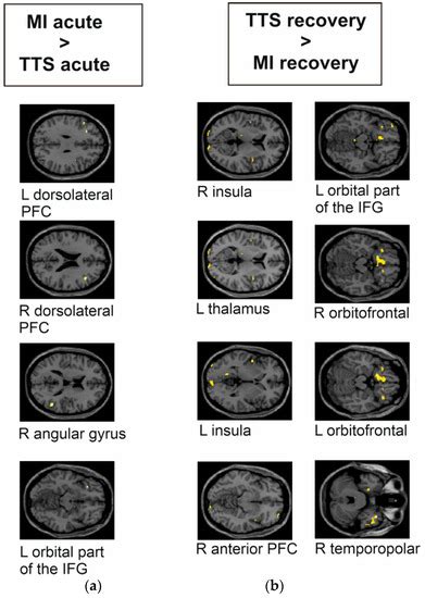 Limbic Responses to Aversive Visual Stimuli during the Acute and ...