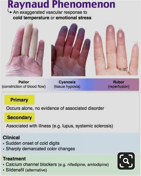 Raynauds Phenomenon Raynaud's Phenomenon (three Color Changes) Of The
