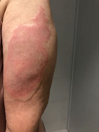 Image result for Injection Reactions