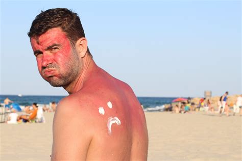 What really happens when you get a sunburn? - High Plains Journal