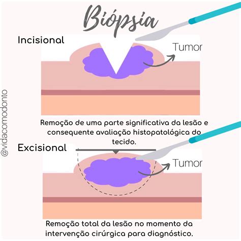 Excisional Vs Incisional Biopsy
