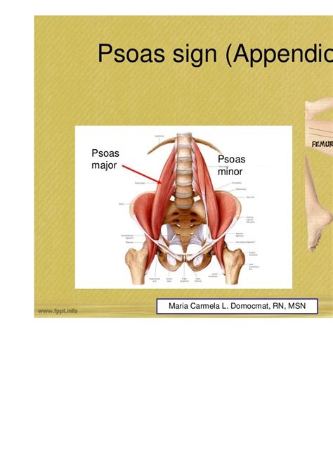 Image result for Psoas Sign