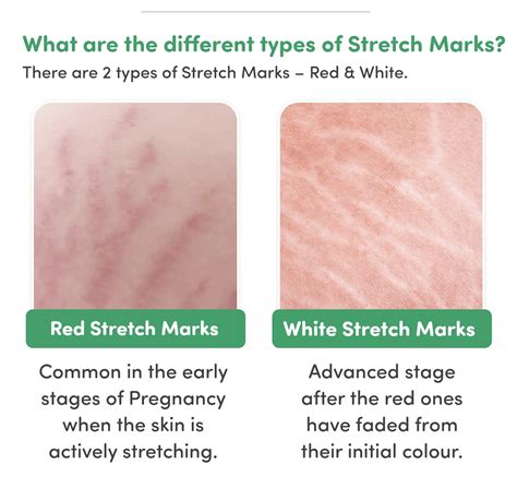 Stretch Mark Kit (Stretch Mark Cream & Stretch Mark Oil) | Mylo Care