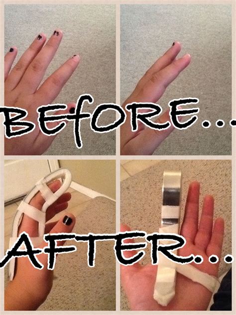 Sprained Index Finger