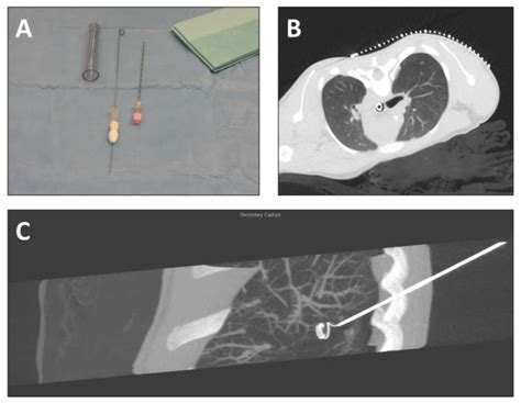 Medical Term Meaning Surgical Puncture Of Lung at Zoe Szabados blog