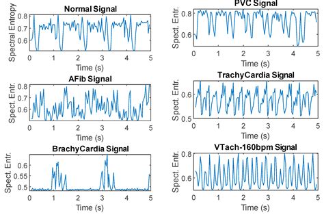 The Use of Time-Frequency Moments as Inputs of LSTM Network for ECG ...