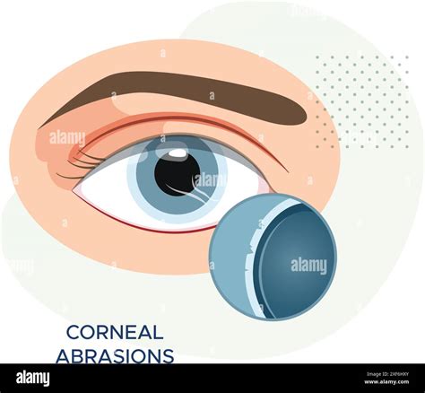 Corneal Abrasions - superficial scratch on Cornea - Stock Illustration as EPS 10 File Stock ...
