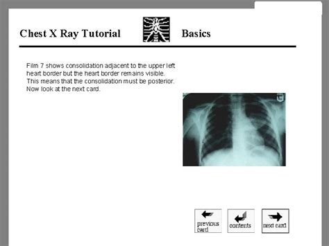 Image result for Chest X-Ray Tutorial