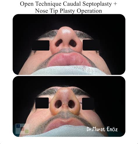 Caudal Septal Deviation