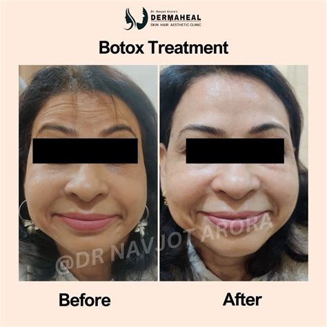 Botox Treatment in Dwarka | Anti-Wrinkle Injections Delhi – Dermaheal ...