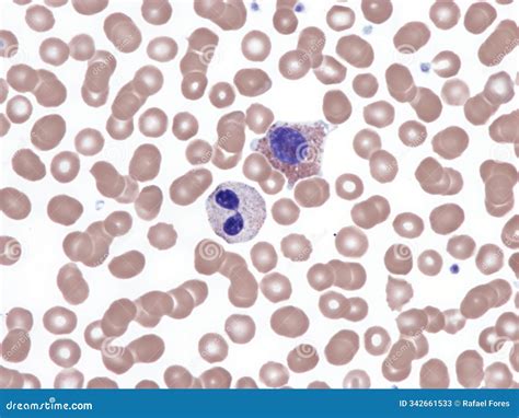 Pelger–Huët anomaly. stock image. Image of cells, peanut - 342661533