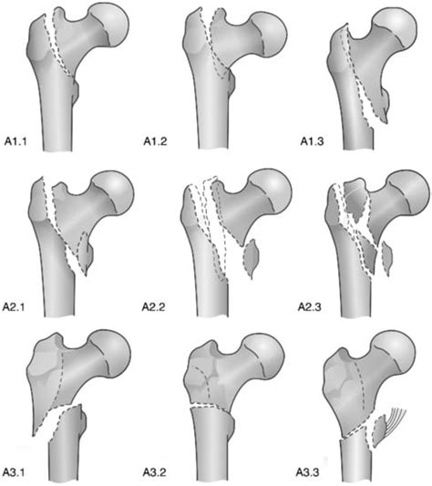 Proximal Femoral Fractures in the Elderly: A Few Things to Know, and ...