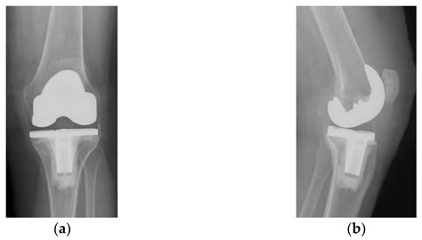 Patellar Resurfacing in Total Knee Arthroplasty, a Never-Ending Controversy; Case Report and ...