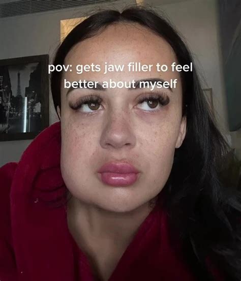 I got jaw filler to feel better about myself — it ruined my life