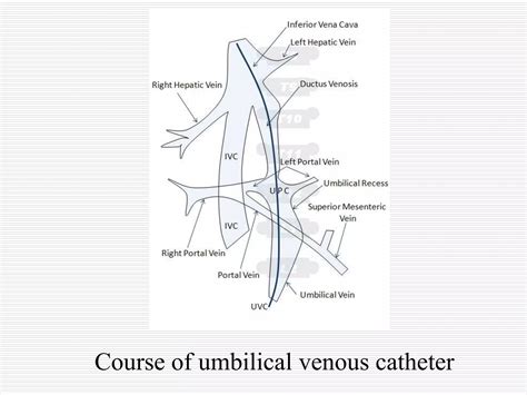 Neonatal Umbilical Venous Catherization Radiology | PPT