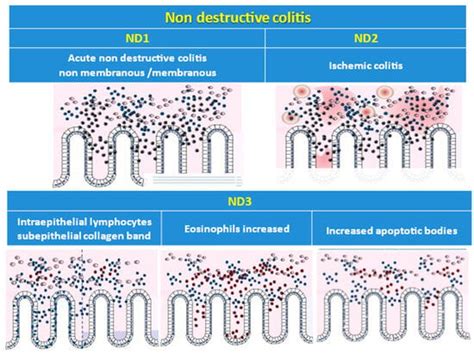 The Histology-Driven Differential Diagnosis in Bowel Inflammatory ...