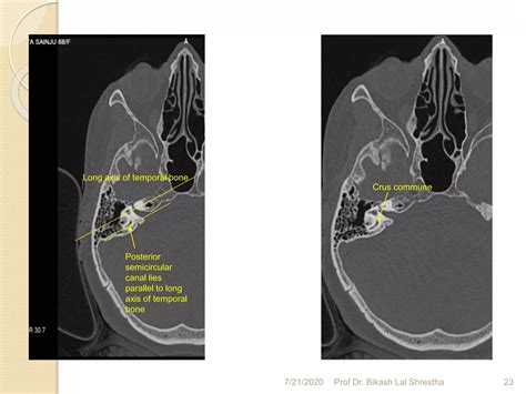 How to read ct scan temporal bone - A dhulikhel hospital, kathmandu ...