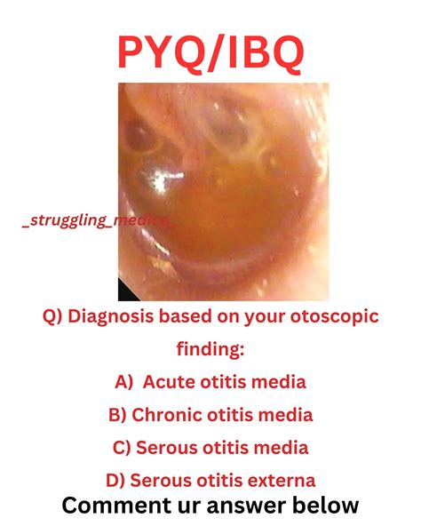 Acute Serous Otitis Media