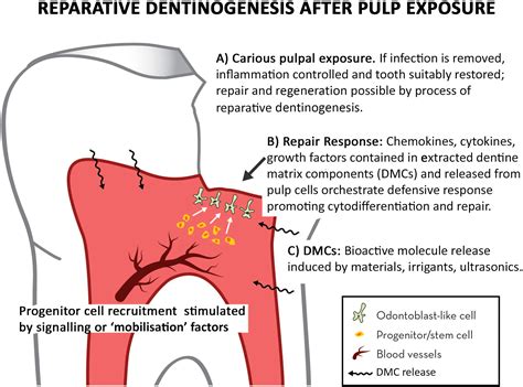 Management of deep caries and the exposed pulp - Bjørndal - 2019 - International Endodontic ...