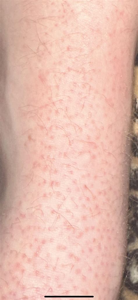 Skin rash on feet? Does anyone know what it is? : r/DermatologyQuestions