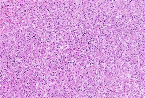 Renal Angiomyolipoma Gross