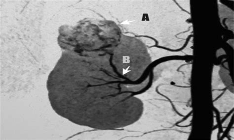 Image result for Retroperitoneal Approach Nephrectomy