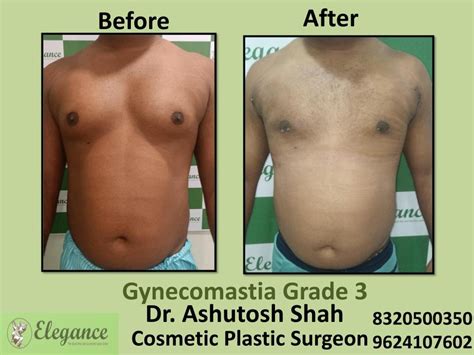 Gyencomastia Grade 3, Male Breast Reduction, Surgical Procedure, Rander ...