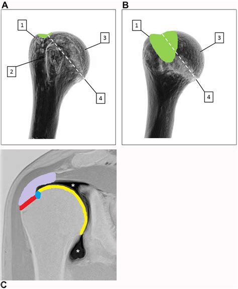 Mimickers of Hill-Sachs Lesions - PMC