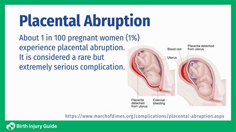 Placenta Previa Vs Abruptio Nursing #nurse #nurses #nursinghomes