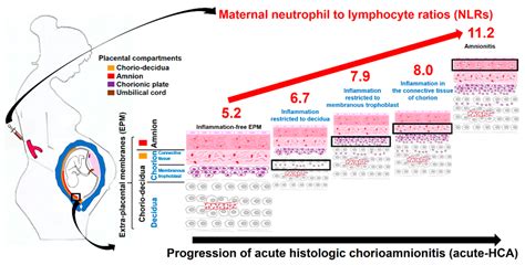 Neutrophil to Lymphocyte Ratio in Maternal Blood: A Clue to Suspect ...