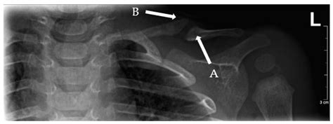 Clavicle Fracture Newborn