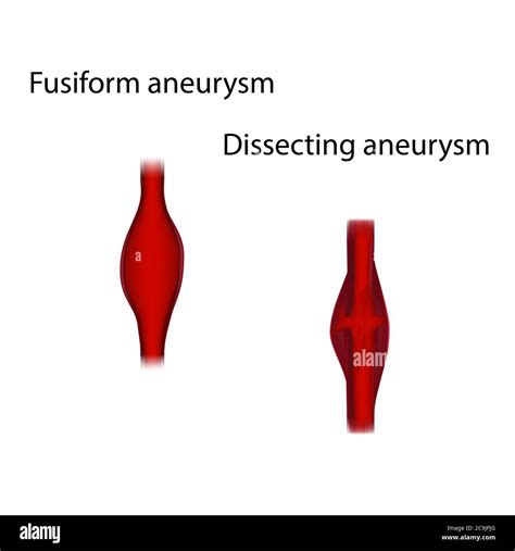 Dissecting Aneurysm Thoracic Aortic Aneurysm And Aortic Dissection