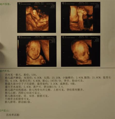 胎儿性别决定是在（ ）A．胎儿生殖器官发育过程中B．受精卵形成时C．精子形成时D．胎儿出生_百度宝宝知道-决定胎儿性别的时期是（ ）A．受精卵 ...
