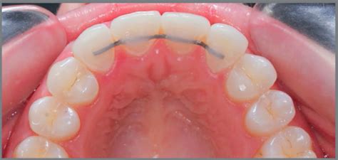 Image result for Retainer Problems